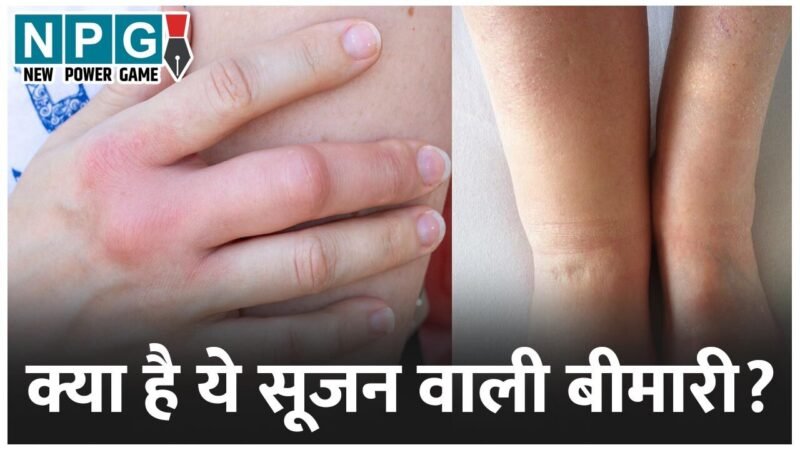 Health News: क्या है ये सूजन वाली बीमारी? जिसकी वजह से गई इस मशहूर एक्ट्रेस की जान, जानें इसे आपको कितना है खतरा…