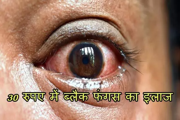 Black Fungus Treatment: लखनऊ: मात्र 30 रुपए के टैबलेट से ठीक होगा ब्लैक फंगस…KGMU के रिसर्च में हुआ खुलासा