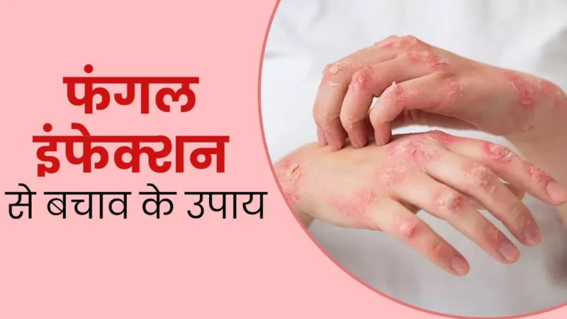 Fungal Infection: उमस के कारण बढ़ जाता है फंगल इंफेक्‍शन का खतरा, जानिए बचाव के घरेलू उपाय