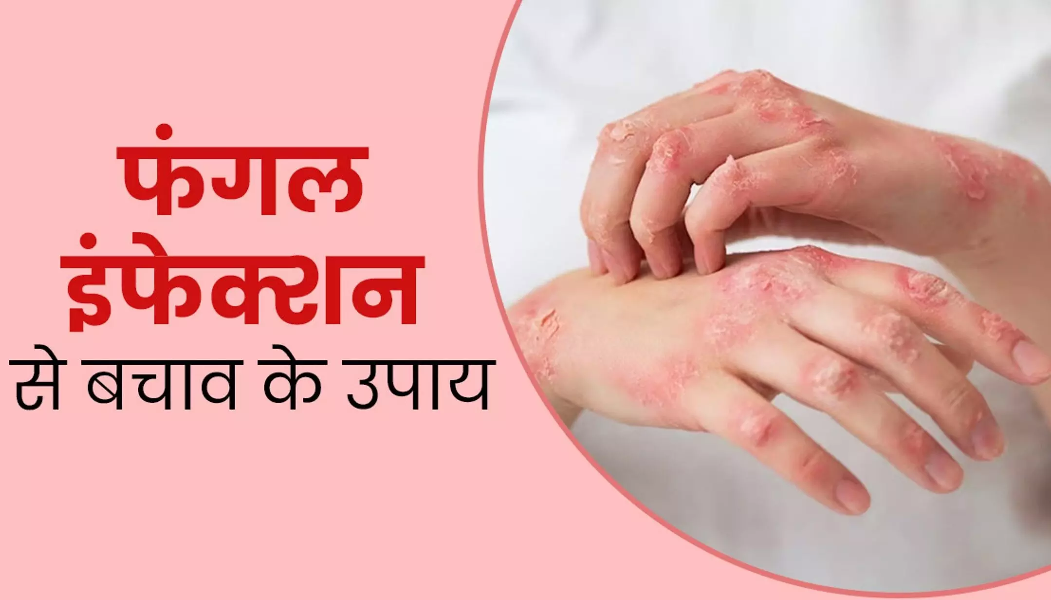 Fungal Infection: उमस के कारण बढ़ जाता है फंगल इंफेक्शन का खतरा, जानिए बचाव के घरेलू उपाय