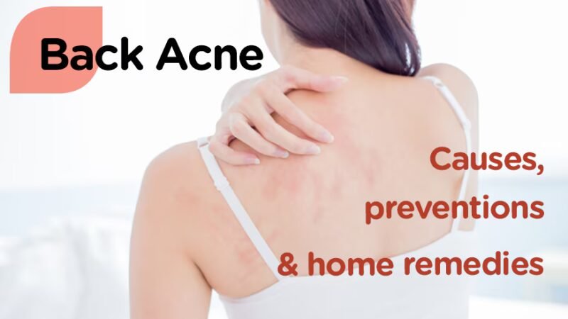 Home Remedies for Back Acne : क्या आपको भी हो रहे पीठ और बांहों पर "एक्ने", तो ये रहे घरेलू उपाय