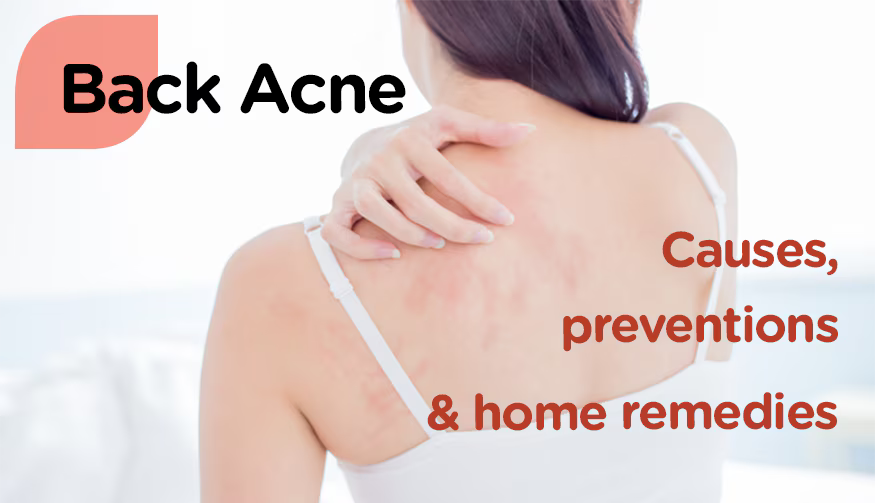 Home Remedies for Back Acne : क्या आपको भी हो रहे पीठ और बांहों पर "एक्ने", तो ये रहे घरेलू उपाय