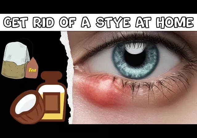 Home remedies for stye : बारिश में आंखों में संक्रमण आम बात… घरेलु उपाय से बचे "बिलनी या गुहेरी" से