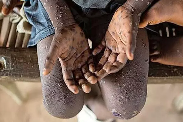 India Monkeypox Alert: दुनिया भर में फैल रहा Mpox, केंद्र ने जारी किया अलर्ट, जानिए क्या है इसके लक्षण