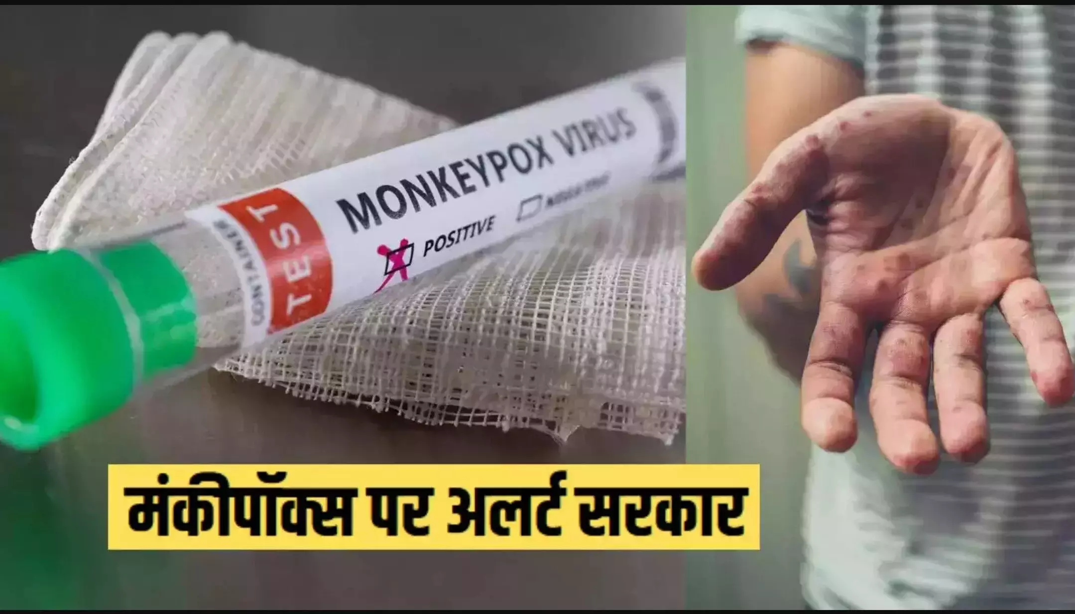Monkeypox cases in India: कोरोना के बाद मंकीपॉक्स का कहर, भारत में मंकीपॉक्स को लेकर अलर्ट, बॉर्डर और एयरपोर्ट पर शुरू हुई निगरानी