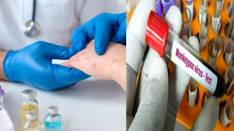 CG: मंकी पॉक्स को लेकर एडवायजरी जारी, जानिए क्या है ये बीमारी और कैसे करें बचाव व रोकथाम…