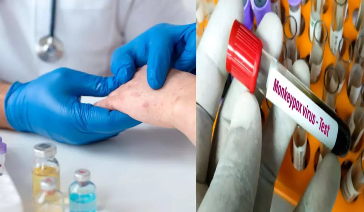 CG: मंकी पॉक्स को लेकर एडवायजरी जारी, जानिए क्या है ये बीमारी और कैसे करें बचाव व रोकथाम…