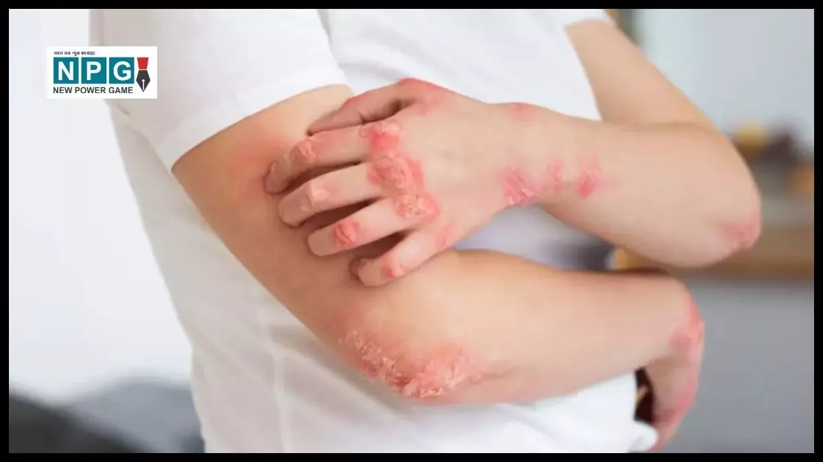 Skin Disease: सोरायसिस, त्वचा की गंभीर समस्या और इसके आधुनिक इलाज