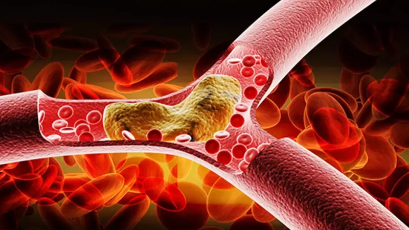 High Cholesterol Symptoms: सर्दियों में हाई कोलेस्ट्रॉल से बचें: जानें इसके लक्षण और उपाय…