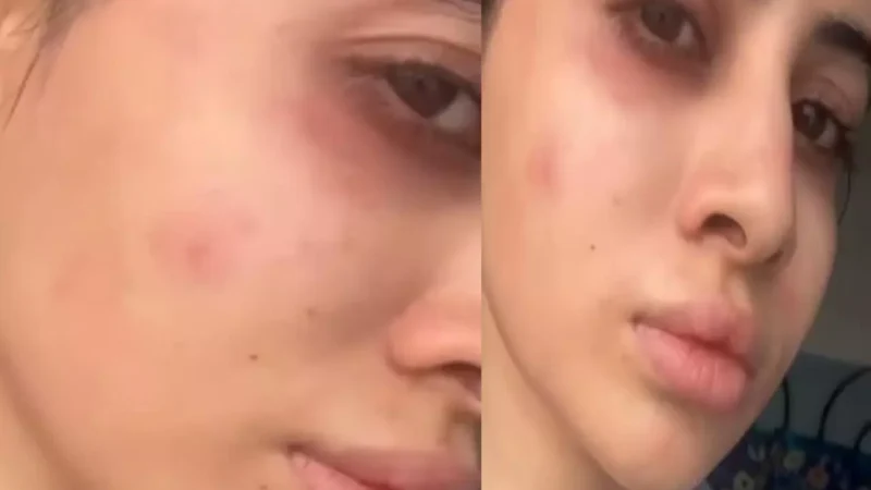 Urfi Javed News: उर्फी के साथ हुआ बड़ा हादसा: चेहरा की हुई ऐसी बुरी हालत, शक्ल पहचान पाना मुश्लिक, देखें वीडियो…