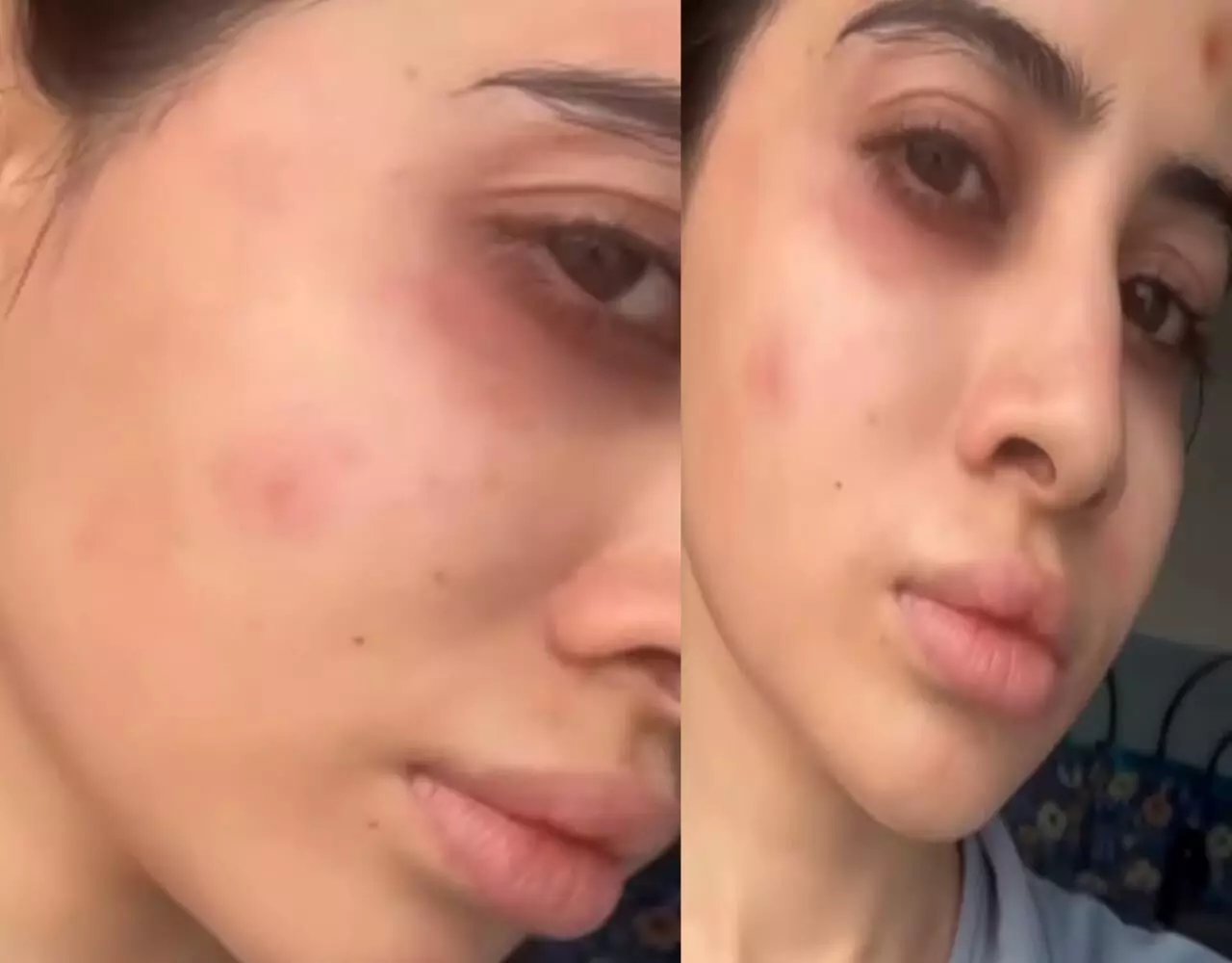 Urfi Javed News: उर्फी के साथ हुआ बड़ा हादसा: चेहरा की हुई ऐसी बुरी हालत, शक्ल पहचान पाना मुश्लिक, देखें वीडियो…