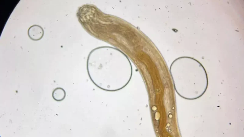 Rare surgery in AIIMS Bhopal:आंख से निकला 1 इंच लंबा कीड़ा, डॉक्टरों ने किया दुर्लभ ऑपरेशन