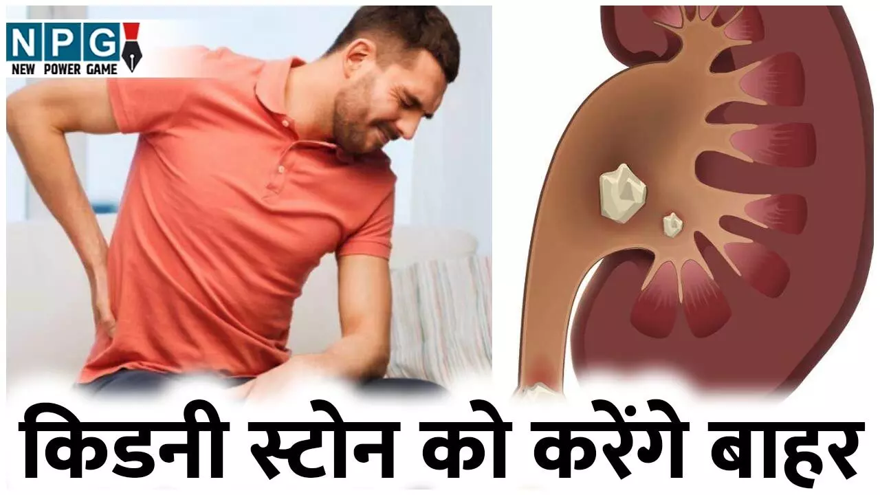 Home Remedies For Kidney Stone: ये घरेलू उपाय किडनी स्टोन को करेंगे बाहर, नहीं सहनी पड़ेगी भयावह पीड़ा…