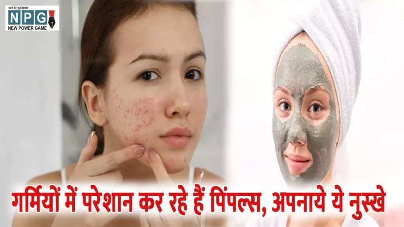 How To Remove Pimples: गर्मियों में हो रहे हैं पिंपल्स, छुटकारा पाने के लिए अपनाये ये असरदार घरेलू उपाय